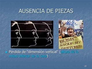 29
AUSENCIA DE PIEZAS
 Pérdida de “dimensión vertical” (altura de la
mitad inferior de la cara)
 