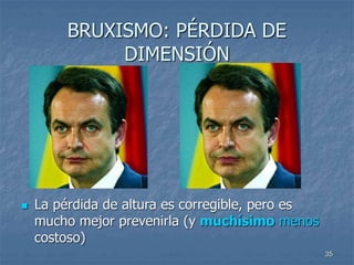 35
BRUXISMO: PÉRDIDA DE
DIMENSIÓN
 La pérdida de altura es corregible, pero es
mucho mejor prevenirla (y muchísimo menos
costoso)
 
