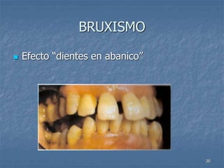 36
BRUXISMO
 Efecto “dientes en abanico”
 