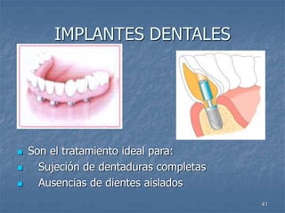 41
IMPLANTES DENTALES
 Son el tratamiento ideal para:
 Sujeción de dentaduras completas
 Ausencias de dientes aislados
 