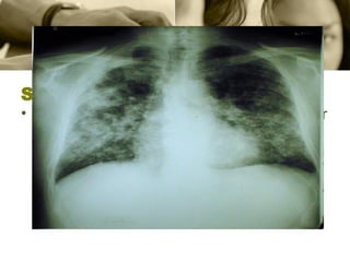 Silicosis La  silicosis  consiste en la  fibrosis  nodular de los  pulmones  y la dificultad para respirar causadas por la inhalación prolongada de compuestos químicos que contienen  sílice  cristalina.  