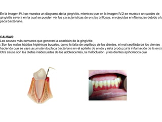 En la imagen IV.I se muestra un diagrama de la gingivitis, mientras que en la imagen IV.2 se muestra un cuadro de gingivitis severa en la cual se pueden ver las características de encías brillosas, enrojecidas e inflamadas debido a la paca bacteriana. CAUSAS:Las causas más comunes que generan la aparición de la gingivitis: · Son los malos hábitos higiénicos bucales, como la falta de cepillado de los dientes, el mal cepillado de los dientes haciendo que se vaya acumulando placa bacteriana en el epitelio de unión y ésta produzca la inflamación de la encía.Otra causa son las dietas inadecuadas de los adolescentes, la maloclusión  y los dientes apiñonados que