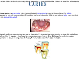 La carie suele comenzar como una grieta en el esmalte (1). A medida que crece, penetra en la dentina hasta llegar a la cavidad de la pulpa y llega hasta los nervios causando un intenso dolor (2). Luego, las bacterias pueden penetrar en los vasos sanguíneos dentales y formar un absceso en la raíz del diente (3). La carie suele comenzar como una grieta en el esmalte (1). A medida que crece, penetra en la dentina hasta llegar a la cavidad de la pulpa y llega hasta los nervios causando un intenso dolor (2). Luego, las bacterias pueden penetrar en los vasos sanguíneos dentales y formar un absceso en la raíz del diente (3). C A R I E SLa caries es una enfermedad infecciosa multifactorial pulpa dentaria produciendo su inflamación, pulpitis, y posterior necrosis (muerte pulpar). El resultado final es la inflamación del área que rodea el ápice o extremo de la raíz, periodontitis apical.  La carie suele comenzar como una grieta en el esmalte (1). A medida que crece, penetra en la dentina hasta llegar a la cavidad de la pulpa y llega hasta los nervios causando un intenso dolor (2). Luego, las bacterias pueden penetrar en los vasos sanguíneos dentales y formar un absceso en la raíz del diente (3). 