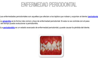     Las enfermedades periodontales son aquellas que afectan a los tejidos que rodean y soportan al diente (periodonto).La gingivitis es la forma más común y leve de enfermedad periodontal. Si esta no se controla con el paso del tiempo puede evolucionar a periodontitis.(La periodontitis es un estado avanzado de enfermedad periodontal y puede causar la pérdida del diente.	  ENFERMEDAD PERIODONTAL