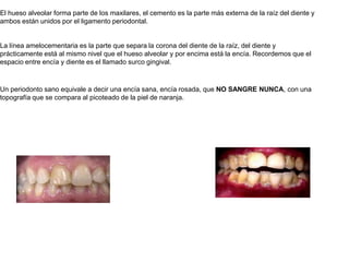 El hueso alveolar forma parte de los maxilares, el cemento es la parte más externa de la raíz del diente y ambos están unidos por el ligamento periodontal.La línea amelocementaria es la parte que separa la corona del diente de la raíz, del diente y prácticamente está al mismo nivel que el hueso alveolar y por encima está la encía. Recordemos que el espacio entre encía y diente es el llamado surco gingival. Un periodonto sano equivale a decir una encía sana, encía rosada, que NO SANGRE NUNCA, con una topografía que se compara al picoteado de la piel de naranja.  
