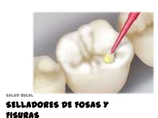 SELLADORES DE FOSAS Y
Salud bucal
 
