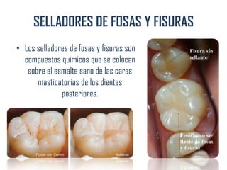 SELLADORES DE FOSAS Y FISURAS
• Los selladores de fosas y fisuras son
compuestos químicos que se colocan
sobre el esmalte sano de las caras
masticatorias de los dientes
posteriores.
 