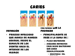 caries
definición
• Proceso infeccioso
que avanza de manera
gradual desde el
esmalte de los
dientes hacia el
interior de los
mismos
Factores que la
producen
• Principalmente se
debe a la suma de :
– Placa bacteriana
– Azúcares refinados
(más ácido bacteriano
que causa
descalcificación
• Resistencia del
 