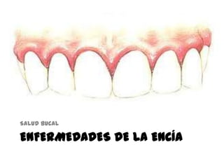 ENFERMEDADES DE LA ENCÍA
Salud bucal
 