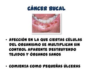 Cáncer bucal
• Afección en la que ciertas células
del organismo se multiplican sin
control aparente destruyendo
tejidos y órganos sanos
• Comienza como pequeñas úlceras
 