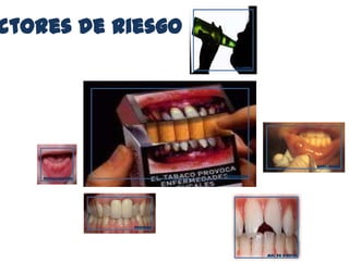 ctores de riesgo
tabaquismo
alcohol
queilofagia
medicamentos
Mal de dientes
prótesis
 