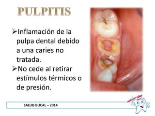 SALUD BUCAL – 2014
Inflamación de la
pulpa dental debido
a una caries no
tratada.
No cede al retirar
estímulos térmicos o
de presión.
 