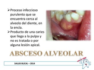 SALUD BUCAL – 2014
Proceso infeccioso
purulento que se
encuentra cerca al
alveolo del diente, en
la encía.
Producto de una caries
que llega a la pulpa y
no es tratada o por
alguna lesión apical.
 