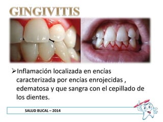 SALUD BUCAL – 2014
Inflamación localizada en encías
caracterizada por encías enrojecidas ,
edematosa y que sangra con el cepillado de
los dientes.
 