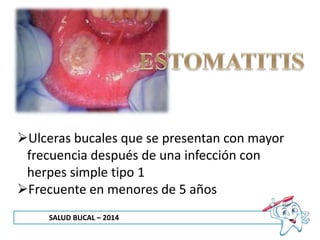 SALUD BUCAL – 2014
Ulceras bucales que se presentan con mayor
frecuencia después de una infección con
herpes simple tipo 1
Frecuente en menores de 5 años
 