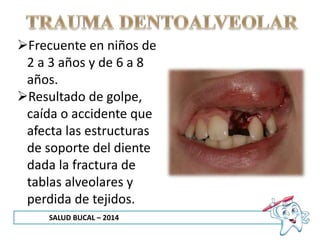 SALUD BUCAL – 2014
Frecuente en niños de
2 a 3 años y de 6 a 8
años.
Resultado de golpe,
caída o accidente que
afecta las estructuras
de soporte del diente
dada la fractura de
tablas alveolares y
perdida de tejidos.
 