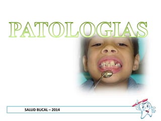 SALUD BUCAL – 2014
 