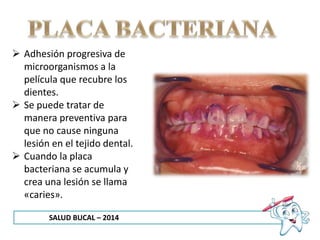 SALUD BUCAL – 2014
 Adhesión progresiva de
microorganismos a la
película que recubre los
dientes.
 Se puede tratar de
manera preventiva para
que no cause ninguna
lesión en el tejido dental.
 Cuando la placa
bacteriana se acumula y
crea una lesión se llama
«caries».
 