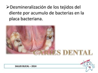 SALUD BUCAL – 2014
Desmineralización de los tejidos del
diente por acumulo de bacterias en la
placa bacteriana.
 