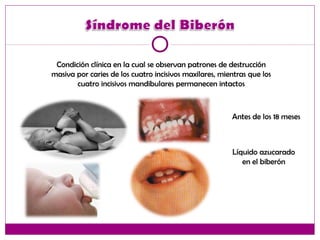 Condición clínica en la cual se observan patrones de destrucción
masiva por caries de los cuatro incisivos maxilares, mientras que los
cuatro incisivos mandibulares permanecen intactos
Líquido azucarado
en el biberón
Antes de los 18 meses
 