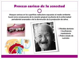 Ataques cariosos en las superficies radiculares expuestas al medio ambiente
bucal como consecuencia de la recesión gingival resultante de la enfermedad
periodontal avanzada o de la disminución de la producción de saliva
oPérdida dentaria
oInsuficiencia
masticatoria
oPobre estado de
nutrición
 