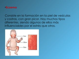 Eczema Consiste en la formación en la piel de vesículas y costras, con gran picor. Hay muchos tipos diferentes, siendo algunos de ellos más influenciables por el estrés que otros. 