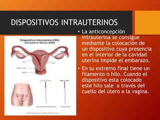 DISPOSITIVOS INTRAUTERINOS 
• La anticoncepción 
intrauterina se consigue 
mediante la colocación de 
un dispositivo cuya presencia 
en el interior de la cavidad 
uterina impide el embarazo. 
• En su extremo final tiene un 
filamento o hilo. Cuando el 
dispositivo esta colocado 
este hilo sale a través del 
cuello del útero a la vagina. 
 