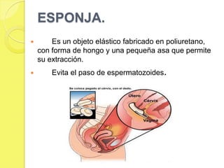 ESPONJA.
       Es un objeto elástico fabricado en poliuretano,
    con forma de hongo y una pequeña asa que permite
    su extracción.
       Evita el paso de espermatozoides.
 