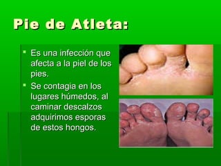 Pie de Atleta:Pie de Atleta:
 Es una infección queEs una infección que
afecta a la piel de losafecta a la piel de los
pies.pies.
 Se contagia en losSe contagia en los
lugares húmedos, allugares húmedos, al
caminar descalzoscaminar descalzos
adquirimos esporasadquirimos esporas
de estos hongos.de estos hongos.
 