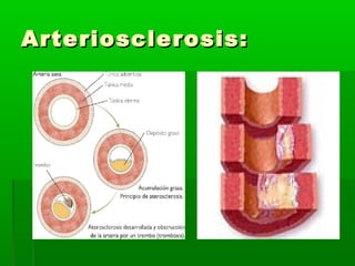 Arteriosclerosis:Arteriosclerosis:
 
