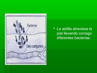  La astilla atraviesa la
piel llevando consigo
diferentes bacterias.
 