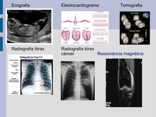 Ecografia

Electrocardiograma

Tomografia

Radiografia tòrax

Radiografia tòrax
càncer
Ressonància magnètica

 