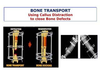 Salvage of bone defects | PPT
