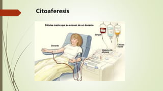 Citoaferesis
 El más usado
 Morbilidad leve
 4-5 inyecciones estimuladoras
 3-4 horas en máquina
 