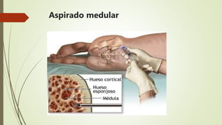 Aspirado medular
 Requiere anestesia e ingreso
 RAMs propias de anestesia y proceso cruento
 El 20% de las donaciones
 1-2 punciones en cada Cresta Ilíaca
 15mL/kg  Autotransfusión
 