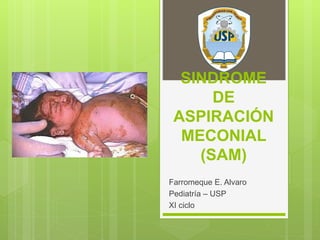 SINDROME
DE
ASPIRACIÓN
MECONIAL
(SAM)
Farromeque E. Alvaro
Pediatría – USP
XI ciclo
 