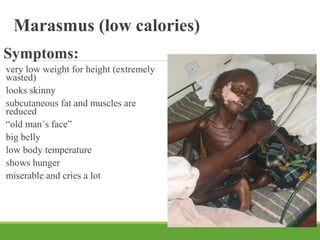 Marasmus (low calories)
Symptoms:
very low weight for height (extremely
wasted)
looks skinny
subcutaneous fat and muscles are
reduced
“old man´s face”
big belly
low body temperature
shows hunger
miserable and cries a lot
 