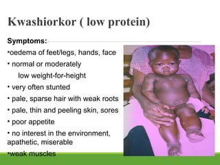Kwashiorkor ( low protein)
Symptoms:
•oedema of feet/legs, hands, face
• normal or moderately
low weight-for-height
• very often stunted
• pale, sparse hair with weak roots
• pale, thin and peeling skin, sores
• poor appetite
• no interest in the environment,
apathetic, miserable
•weak muscles
 