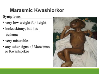 Marasmic Kwashiorkor
Symptoms:
• very low weight for height
• looks skinny, but has
oedema
• very miserable
• any other signs of Marasmus
or Kwashiorkor
 