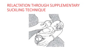 RELACTATION THROUGH SUPPLEMENTARY
SUCKLING TECHNIQUE
 