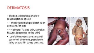 DERMATOSIS
+ mild: discoloration or a few
rough patches of skin
+ + moderate: multiple patches on
arms and/or legs
+ + + severe: flaking skin, raw skin,
fissures (openings in the skin)
• Useful ointments are zinc and
castor oil ointment, petroleum
jelly, or paraffin gauze dressing.
 