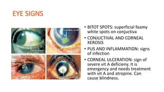 • BITOT SPOTS: superficial foamy
white spots on conjuctiva
• CONJUCTIVAL AND CORNEAL
XEROSIS
• PUS AND INFLAMMATION: signs
of infection
• CORNEAL ULCERATION: sign of
severe vit A deficieny. It is
emergency and needs treatment
with vit A and atropine. Can
cause blindness.
 