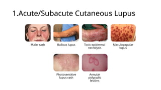 Classifying and Diagnosing of Systemic Lupus Erythematosus | PPTX