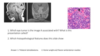 1. Which eye tumor is the image A associated with? What is this
presentation called?
2. Which histopathological features does this slide show
A
B
Answer: 1. Trilateral retinoblastoma. 2. Homer wright and Flexner wintersteiner rosettes
 