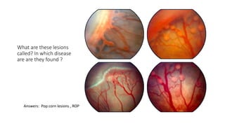 What are these lesions
called? In which disease
are are they found ?
Answers: Pop corn lesions , ROP
 