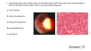 Answer: D
• A patient presents with a fundus shown in the figure below (left). The condi- tion’s histopathology is
shown in the figure below (right). What is your most likely diagnosis?
a. Coats’ disease
b. retinal toxoplasmosis
c. intraocular lymphoma
d. hemangioblastoma.
e. sarcoidosis.
 