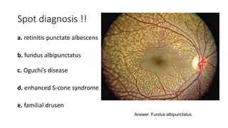 Spot diagnosis !!
a. retinitis punctate albescens
b. fundus albipunctatus
c. Oguchi’s disease
d. enhanced S-cone syndrome
e. familial drusen
Answer: Fundus albipunctatus
 