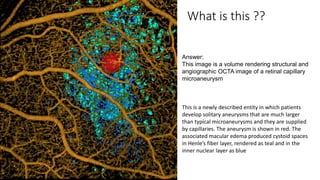 What is this ??
Answer:
This image is a volume rendering structural and
angiographic OCTA image of a retinal capillary
microaneurysm
This is a newly described entity in which patients
develop solitary aneurysms that are much larger
than typical microaneurysms and they are supplied
by capillaries. The aneurysm is shown in red. The
associated macular edema produced cystoid spaces
in Henle’s fiber layer, rendered as teal and in the
inner nuclear layer as blue
 