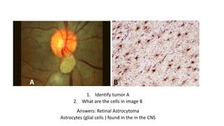 1. Identify tumor A
2. What are the cells in image B
A B
Answers: Retinal Astrocytoma
Astrocytes (glial cells ) found in the in the CNS
 