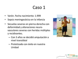 Caso 1
• Varón. Fecha nacimiento: 1.999
• Sepsis meningocócica en la infancia
• Secuelas severas en pierna derecha con
deformidad y alteraciones neuro-
vasculares severas con heridas múltiples
y recidivantes.
– Con 3 años se decidió amputación a
nivel transtibial
– Protetizado con éxito en nuestra
Unidad
 